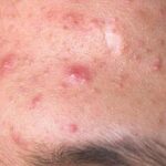 How To Hide Pimples With Makeup ?