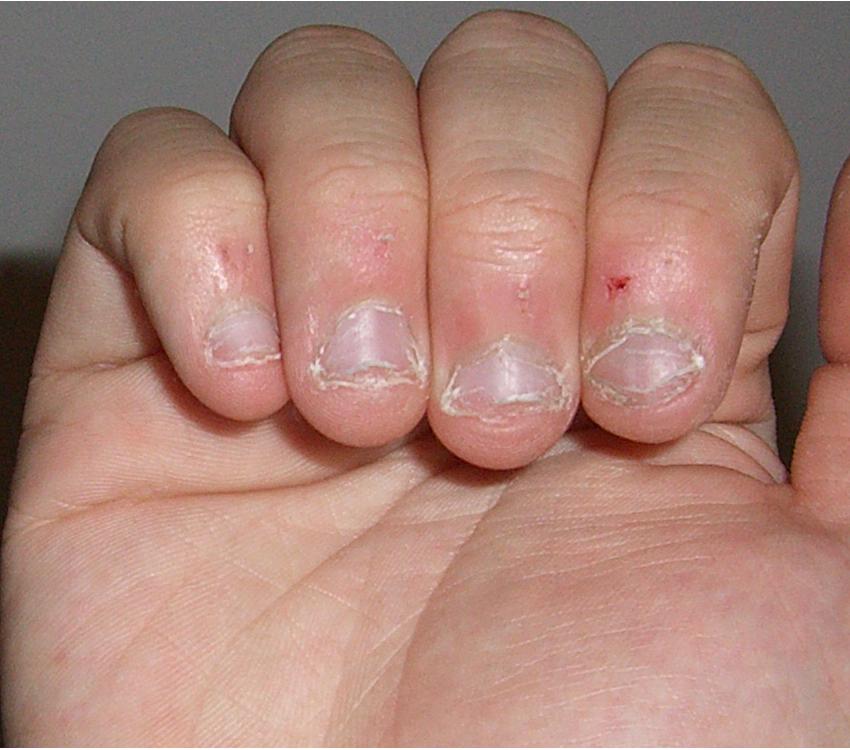 How To Stop Biting Nails In 9 Minutes ?