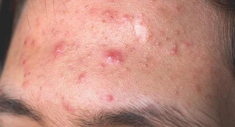 How To Hide Pimples By Makeup ?