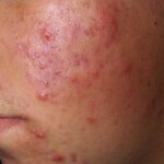 How To Cover Up Blemishes With Makeup ?