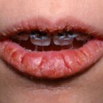 What Is The Cause Of Chapped Lips ?