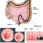 Why Can’t You Wear Makeup During A Colonoscopy ?