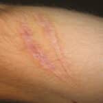 How To Cover Scars With Makeup ?