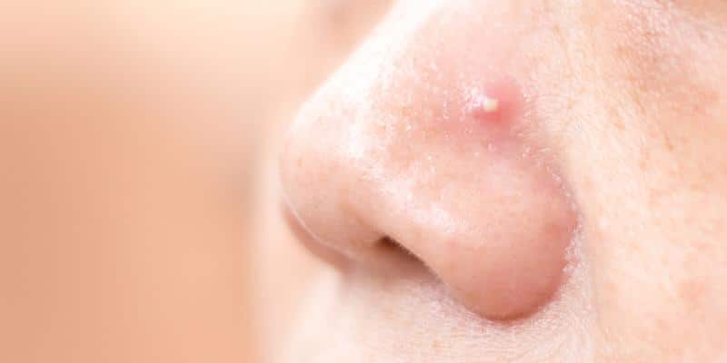 How To Cover Up Zits With Makeup ?