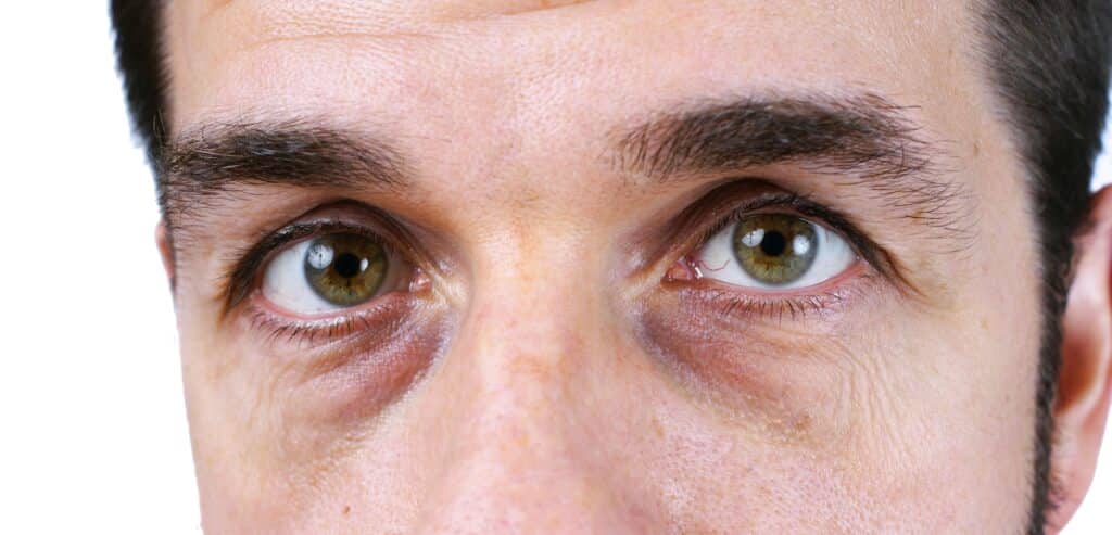 How To Cover Bags Under Eyes With Makeup ?