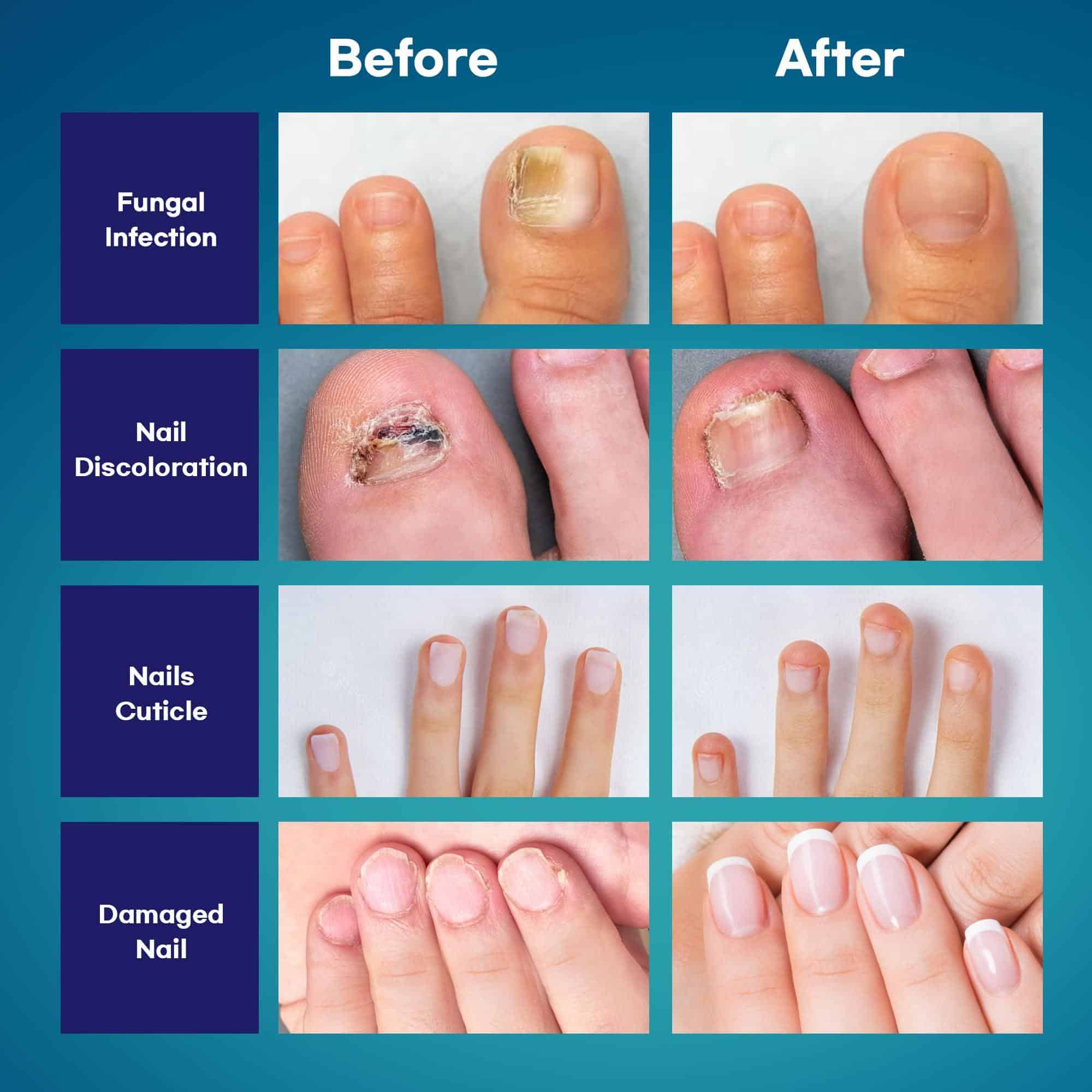 How To Treat Nail Fungus Naturally ? How To Treat Nail Fungus Naturally ?