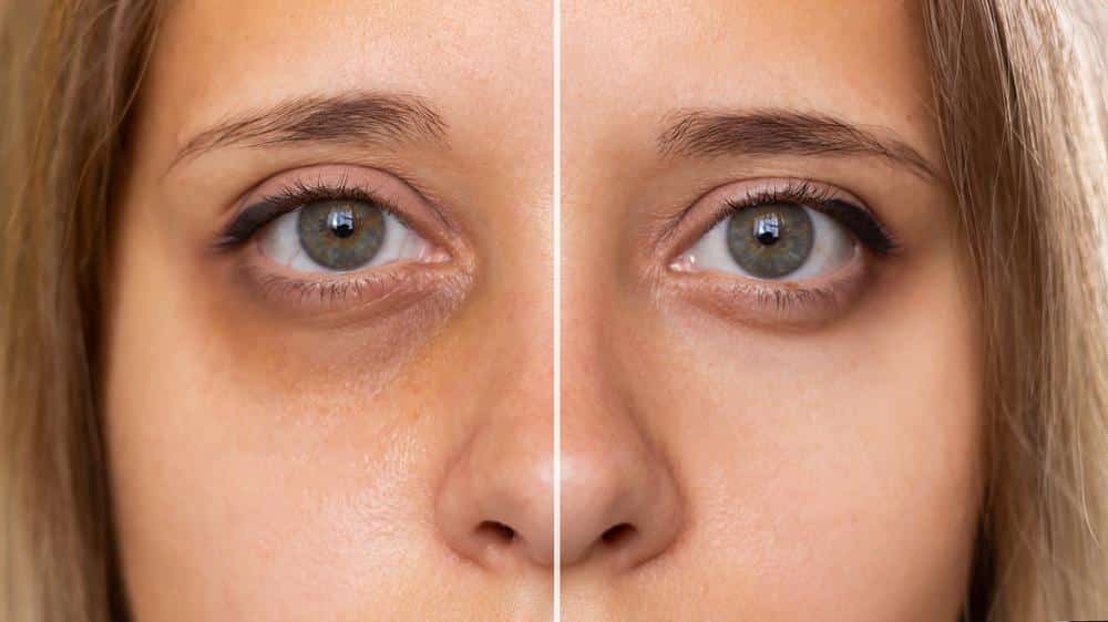 How To Cover Up Dark Circles Without Makeup ? How To Cover Up Dark Circles Without Makeup ?
