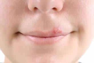 How To Hide Cold Sores Without Makeup ? How To Hide Cold Sores Without Makeup ? How To Hide Cold Sores Without Makeup ? How To Hide Cold Sores Without Makeup ?