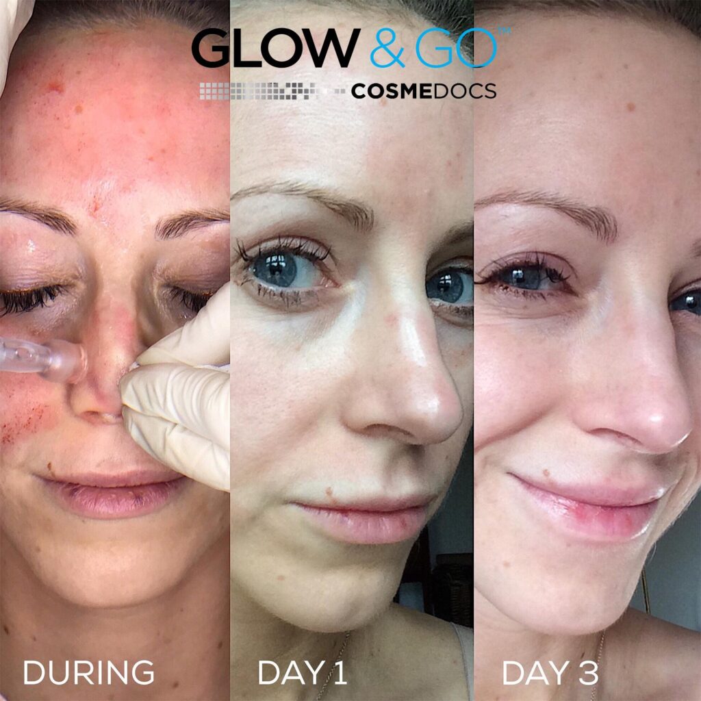How Long After Micro Needling Can I Wear Makeup ?