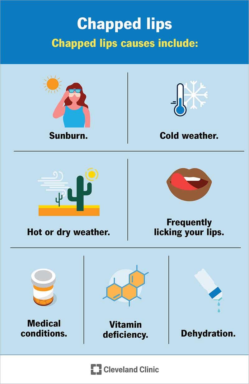 How To Treat Severely Chapped Lips ? How To Treat Severely Chapped Lips ? How To Treat Severely Chapped Lips ? How To Treat Severely Chapped Lips ?