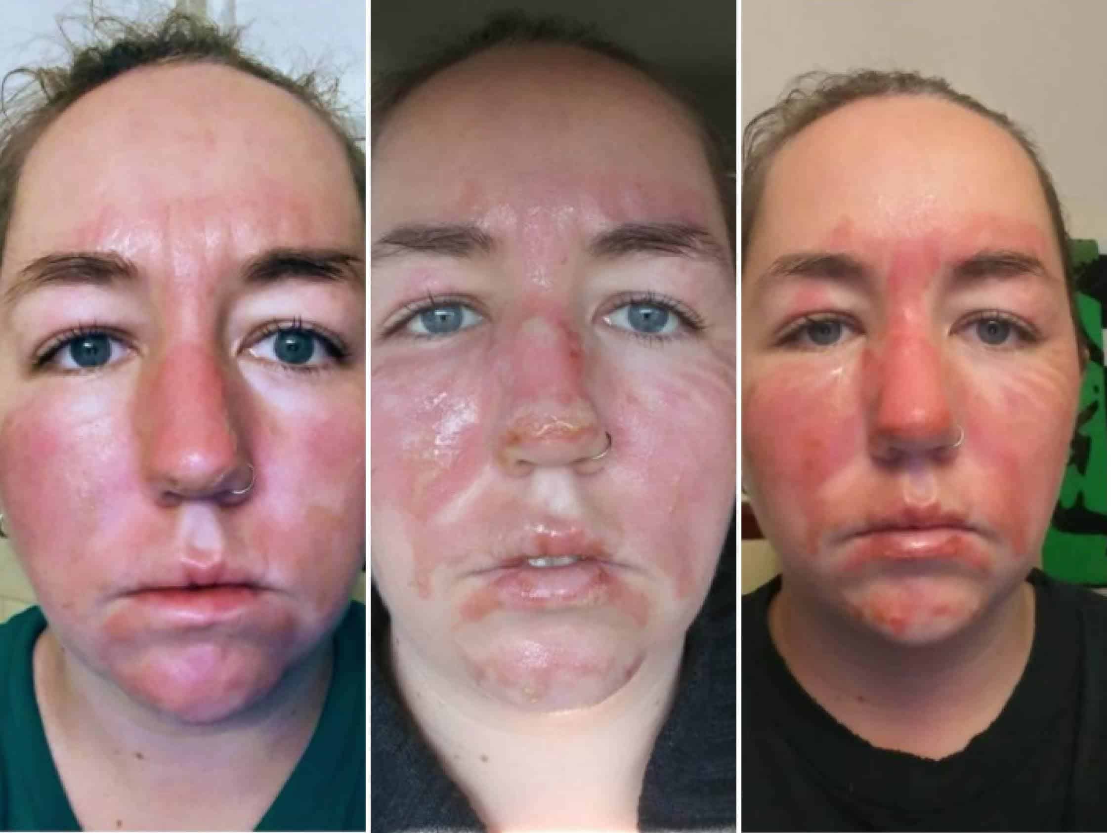 Why Does My Face Burn After Skin Care ? Why Does My Face Burn After Skin Care ? Why Does My Face Burn After Skin Care ? Why Does My Face Burn After Skin Care ?