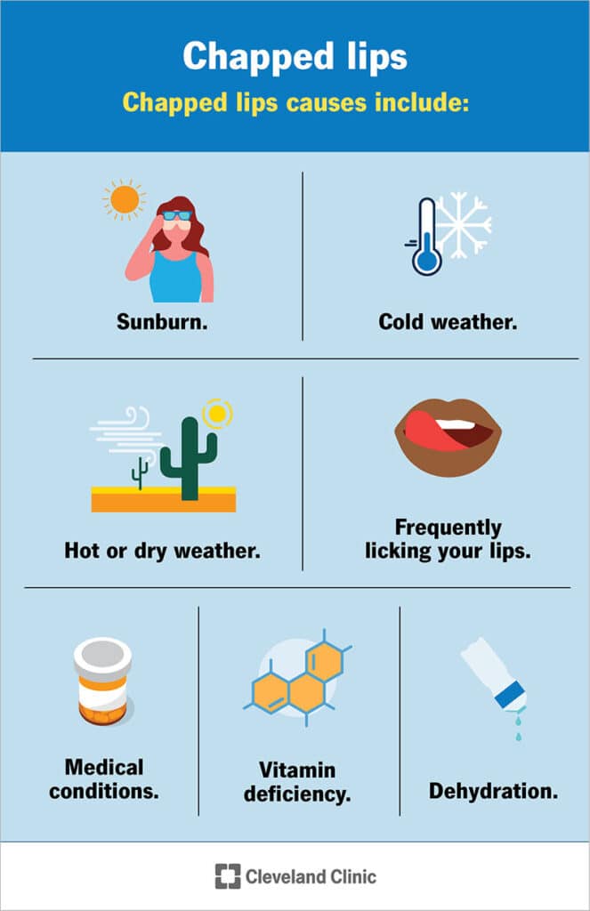 How To Heal Dry Lips ?