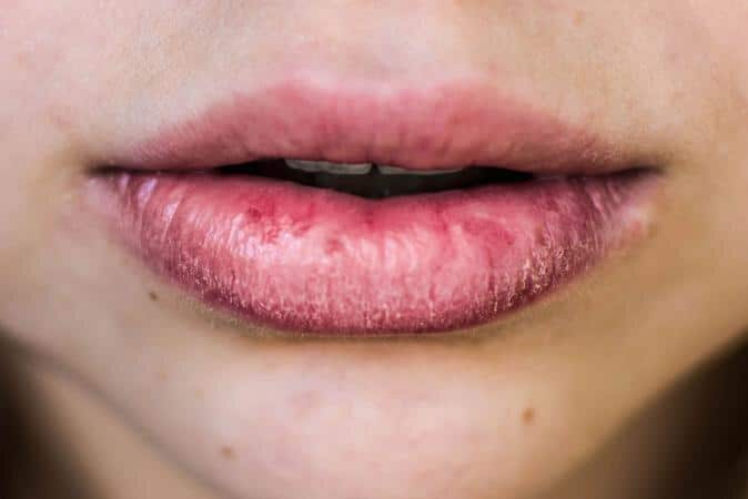 How To Cure Really Chapped Lips ? How To Cure Really Chapped Lips ?