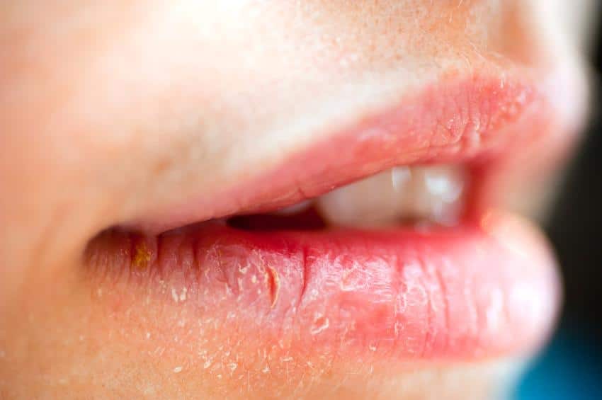 What Cause Cracked Lips At The Corners ?