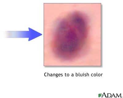 How To Cover A Purple Bruise With Makeup ?  How To Cover A Purple Bruise With Makeup ?