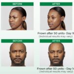 How Long After Dysport Can I Wear Makeup ?