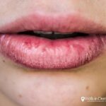 How To Soothe Chapped Lips Fast ?