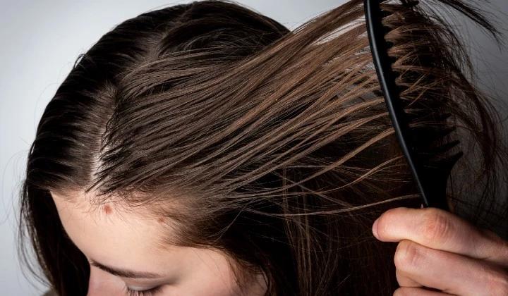 Does Oily Scalp Cause Hair Loss ?