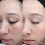Can I Wear Makeup After Glycolic Peel ?