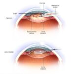 When Can I Wear Eyeliner After Cataract Surgery ?