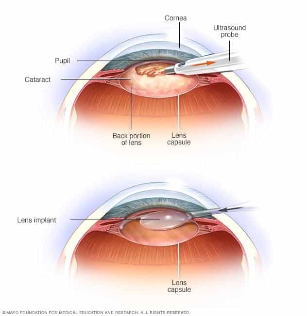 When Can I Wear Eyeliner After Cataract Surgery ?
