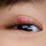 Can Styes Be Caused By Makeup ?