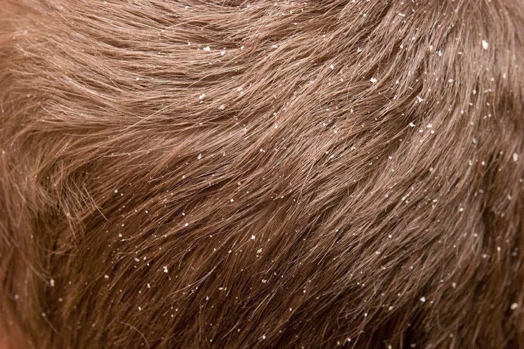 Can Dandruff Lead To Hair Loss ?