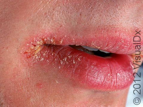 How To Get Rid Of Red Chapped Lips Fast ? How To Get Rid Of Red Chapped Lips Fast ? How To Get Rid Of Red Chapped Lips Fast ? How To Get Rid Of Red Chapped Lips Fast ?