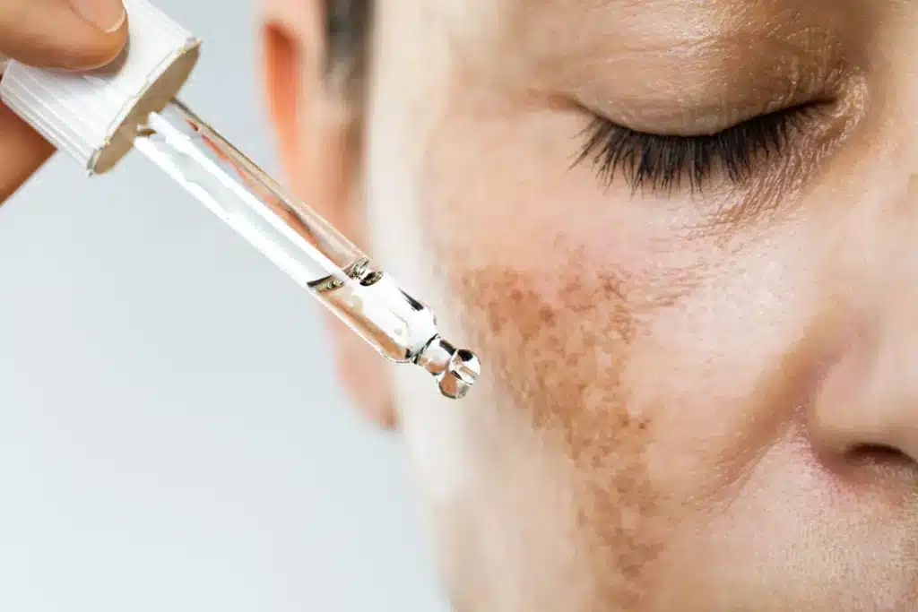 How To Cover Melasma With Makeup ? How To Cover Melasma With Makeup ? How To Cover Melasma With Makeup ? How To Cover Melasma With Makeup ?