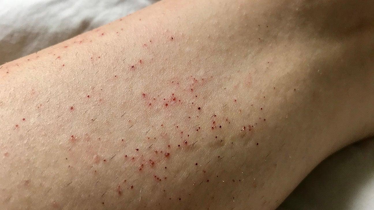 How To Get Shave Bumps To Go Away for women? How To Get Shave Bumps To Go Away for women?