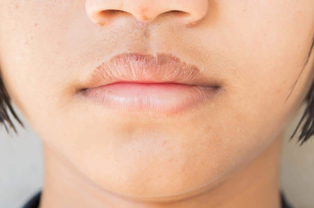 How Can I Get Rid Of Chapped Lips Fast ? How Can I Get Rid Of Chapped Lips Fast ? How Can I Get Rid Of Chapped Lips Fast ? How Can I Get Rid Of Chapped Lips Fast ?