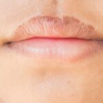 How To Fix Extremely Chapped Lips ?