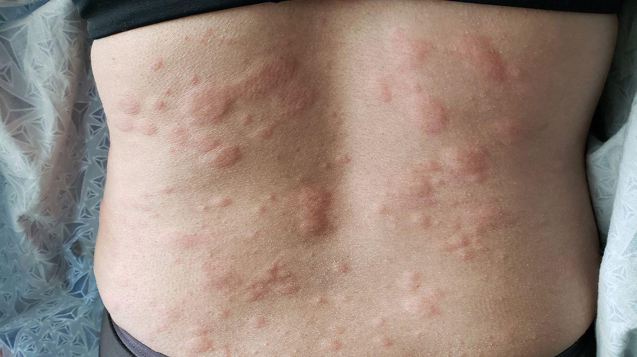 How To Treat Allergic Reaction To Makeup ? How To Treat Allergic Reaction To Makeup ? How To Treat Allergic Reaction To Makeup ? How To Treat Allergic Reaction To Makeup ?