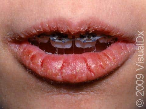 How To Get Rid Of Chapped Lips Fast Overnight ? How To Get Rid Of Chapped Lips Fast Overnight ?