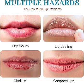 How Do You Cure Chapped Lips ? How Do You Cure Chapped Lips ?
