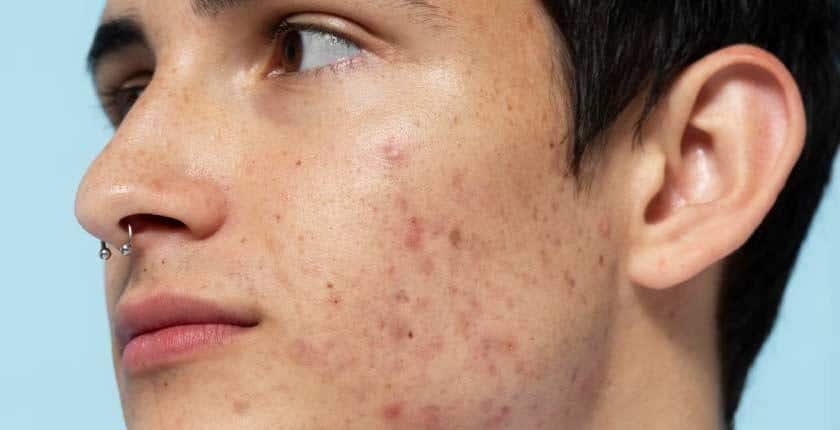 What Is Purging In Skin Care ? What Is Purging In Skin Care ?