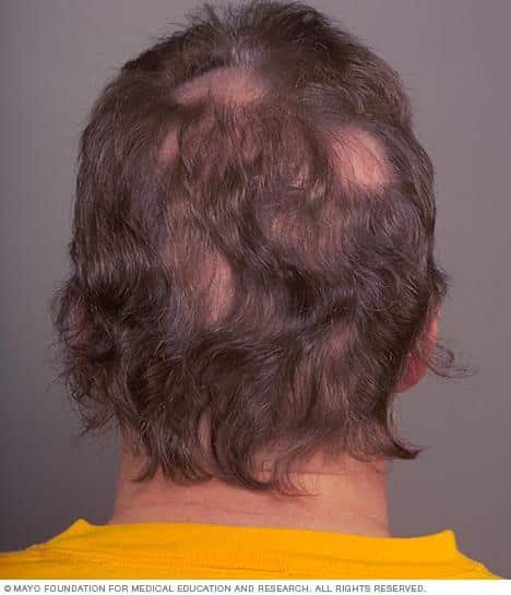 How To Stop Hair Loss From Adderall ? How To Stop Hair Loss From Adderall ?