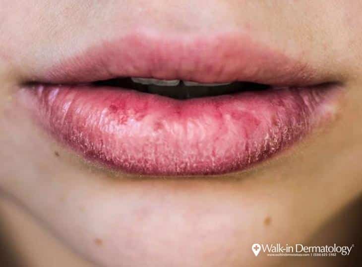 What To Use On Extremely Chapped Lips ? What To Use On Extremely Chapped Lips ?
