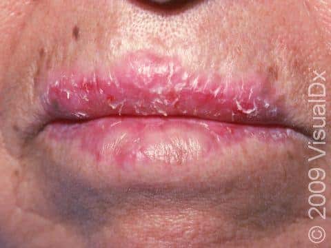 How Do You Heal Dry Cracked Lips ? How Do You Heal Dry Cracked Lips ?