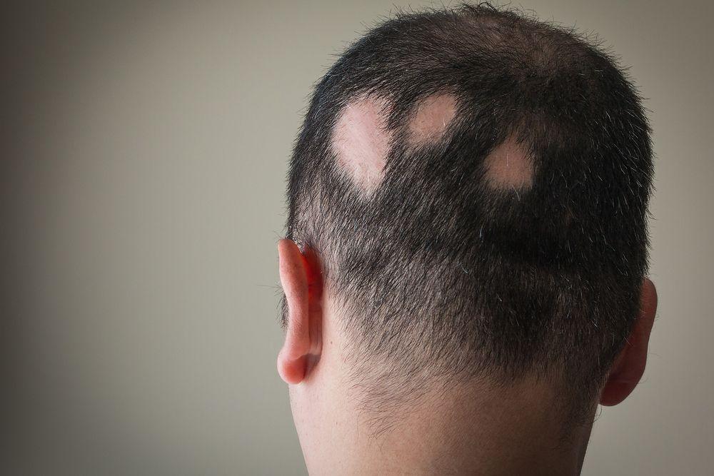 Will Hair Loss From Diabetes Grow Back ? Will Hair Loss From Diabetes Grow Back ?