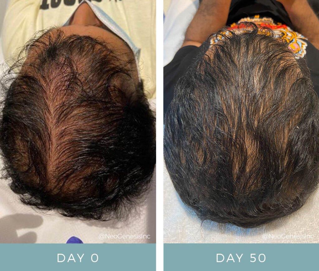 How Often To Microneedle For Hair Loss ? How Often To Microneedle For Hair Loss ? How Often To Microneedle For Hair Loss ? How Often To Microneedle For Hair Loss ?