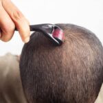How Often To Microneedle For Hair Loss ?