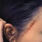 Why Does Hair Dye Burn ?