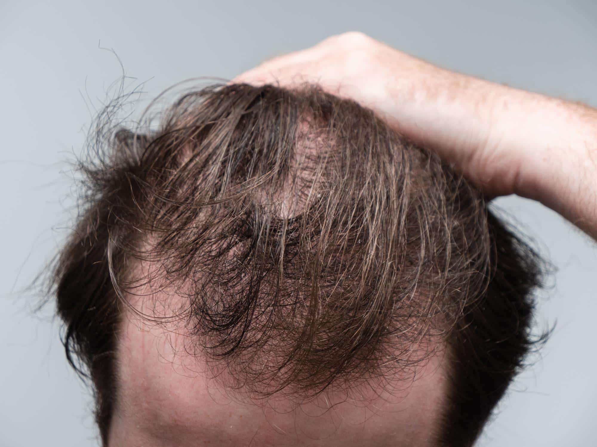 How To Stop Mounjaro Hair Loss ? How To Stop Mounjaro Hair Loss ?