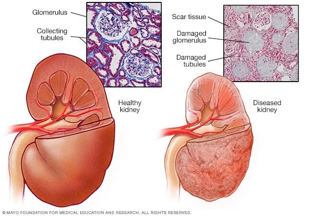 Does Kidney Disease Cause Hair Loss ? Does Kidney Disease Cause Hair Loss ?
