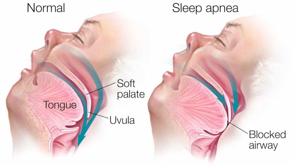Can Sleep Apnea Cause Hair Loss ? Can Sleep Apnea Cause Hair Loss ? Can Sleep Apnea Cause Hair Loss ? Can Sleep Apnea Cause Hair Loss ?