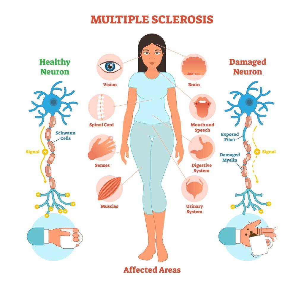 Does Ms Cause Hair Loss ? Does Ms Cause Hair Loss ? Does Ms Cause Hair Loss ? Does Ms Cause Hair Loss ?