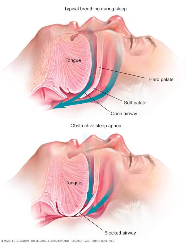 Can Sleep Apnea Cause Hair Loss ?
