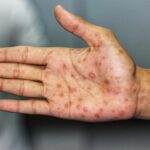 Does Syphilis Cause Hair Loss ?