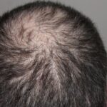 Does Melatonin Cause Hair Loss ?